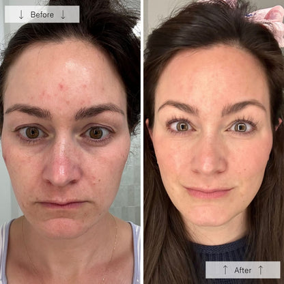 RegenLED Contour Mask