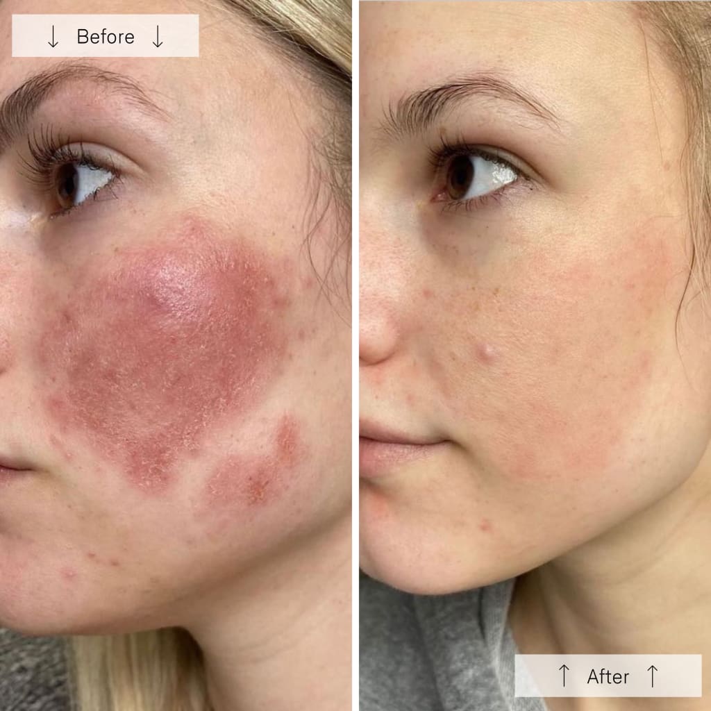 RegenLED Contour Mask